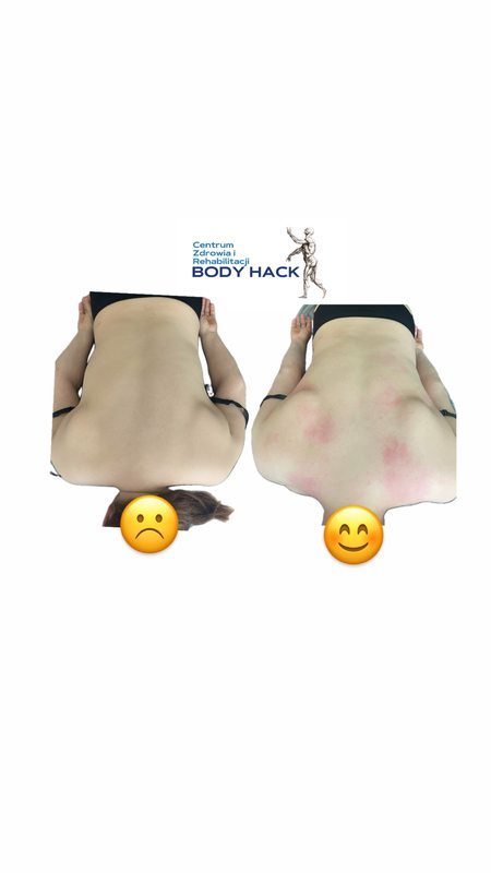 Efekt terapii miofascjalnej pleców w BODY HACK Warszawa